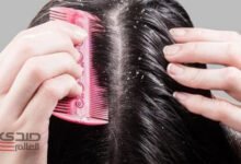 3 وصفات طبيعية للتخلص من قشرة الشعر نهائياً