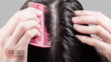 3 وصفات طبيعية للتخلص من قشرة الشعر نهائياً