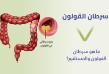 أعراض سرطان القولون.. أهمية الكشف المبكر
