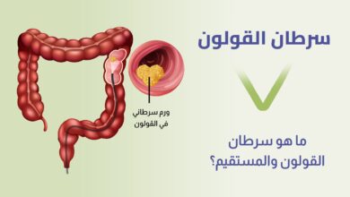 أعراض سرطان القولون.. أهمية الكشف المبكر