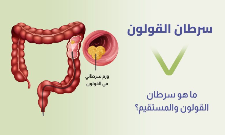 أعراض سرطان القولون.. أهمية الكشف المبكر